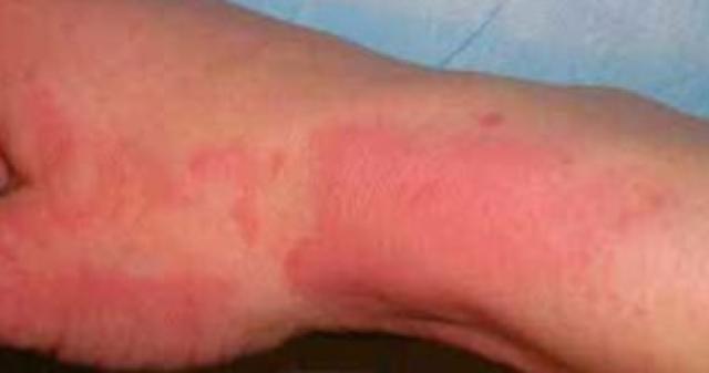  حروق الشمس