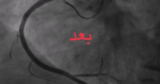 بعد إجراء العملية