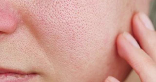 طرق طبيعية للتخلص من أحمرار الخدود