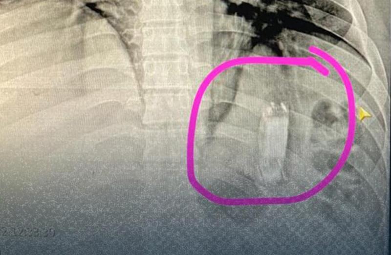 استخراج هاتف محمول من معدة مريض