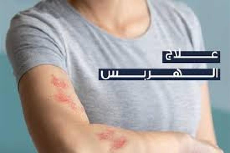  نصائح هامة لمواجهة عدوى الهربس