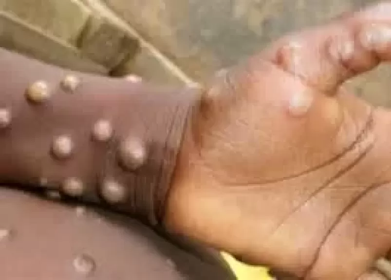 جدرى القرود