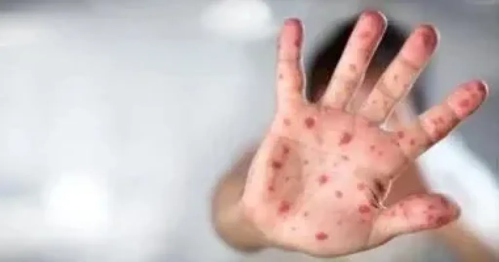 جدرى القرود