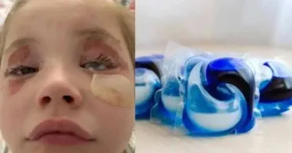 انفجار مسحوق غسيل فى عين طفلة