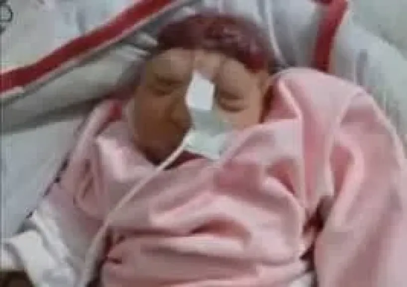 ولادة طفله بلا دماغ