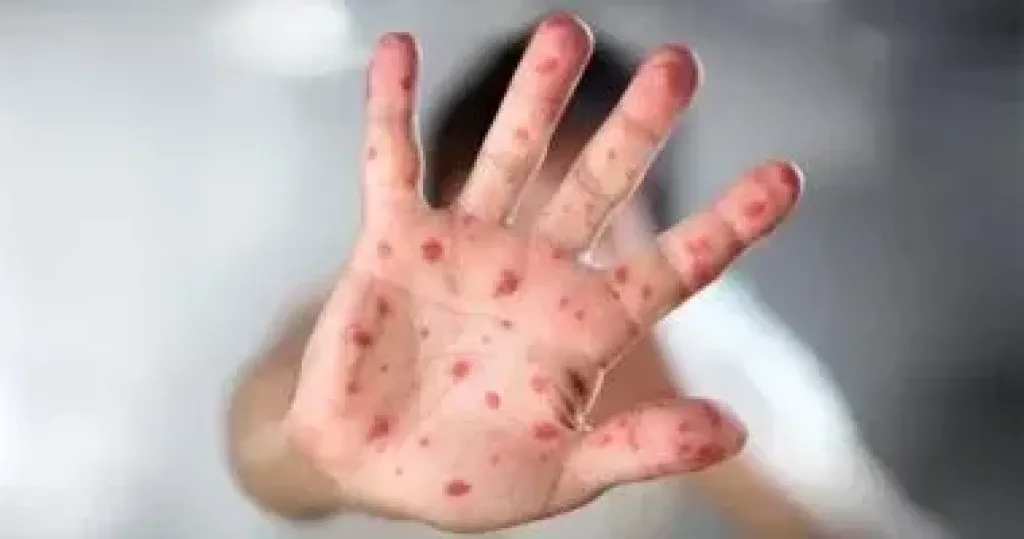 فيروس HFMD  