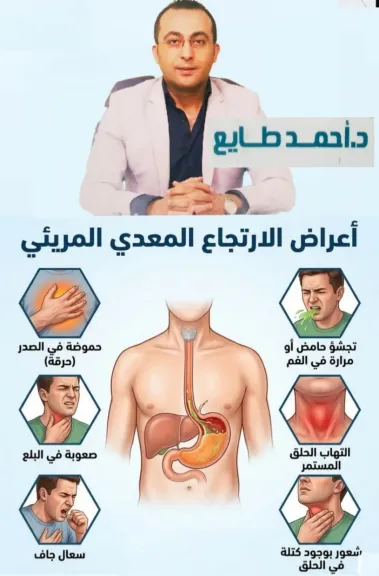 دكتور أحمد.طايع يكشف اعراض ارتجاع المريء واسبابه