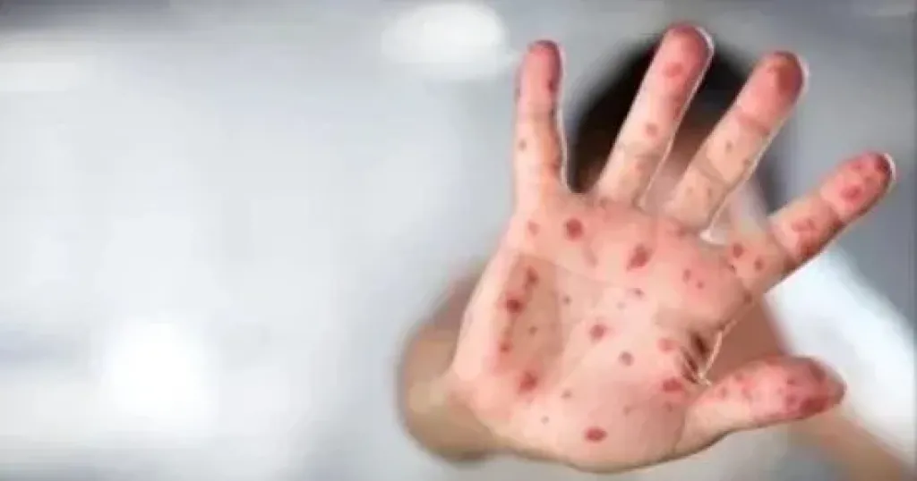 جدرى القرود  