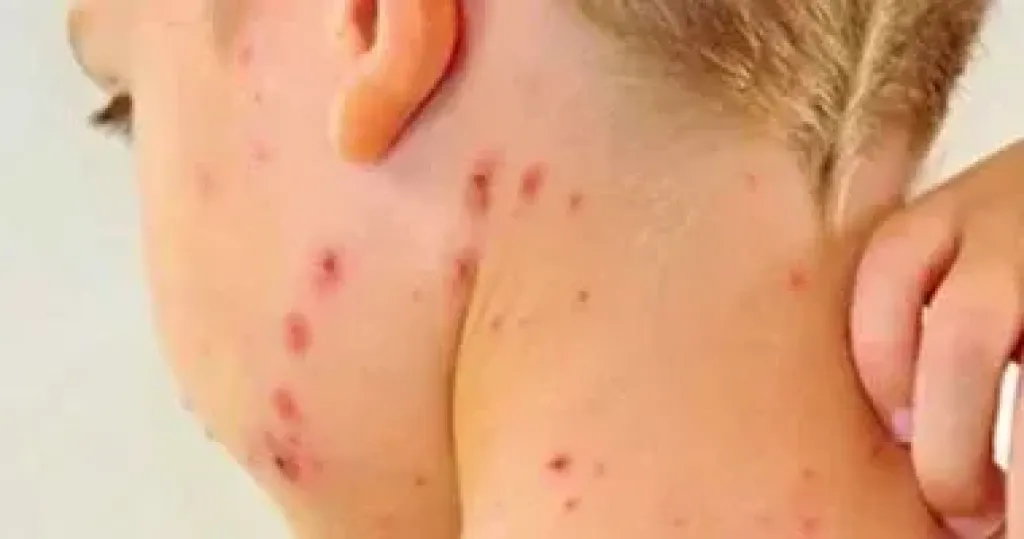 الصحة تحذر من انتشار الحصبة بين الأطفال 